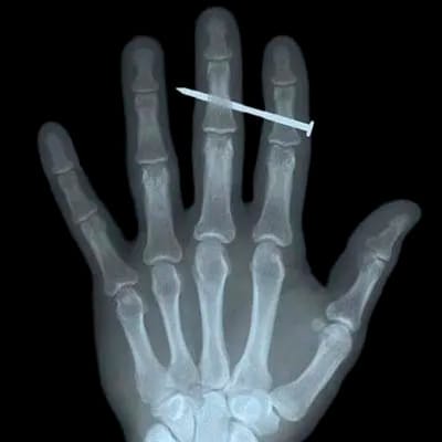 X-ray image of a left hand with a construction nail skewering the middle phalanx of the middle finger.